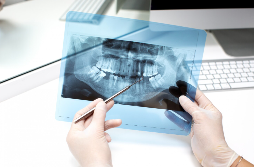 Endodoncia en Valladolid