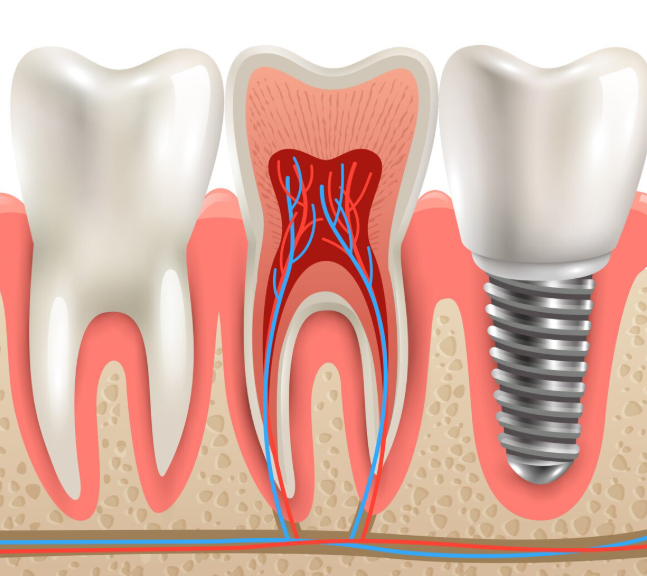 Implante dental en Valladolid: cuándo necesitas un implante cigomático